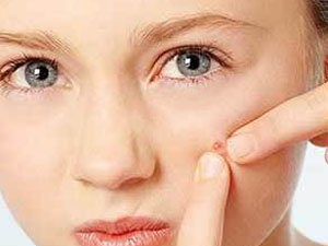 脸上痘坑怎么治疗 用高浓度的果酸促使老化角质层脱落