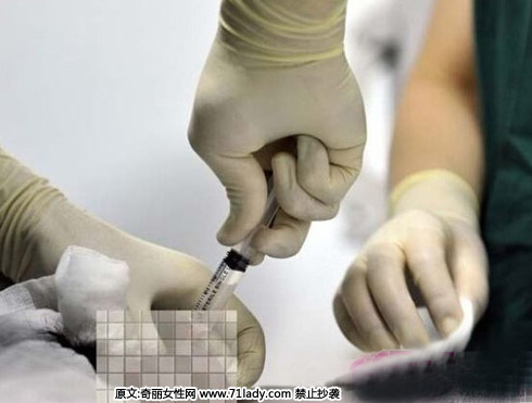医生在抽取精子。