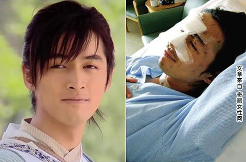 胡歌车祸前后照片 车祸毁容后容貌大变样
