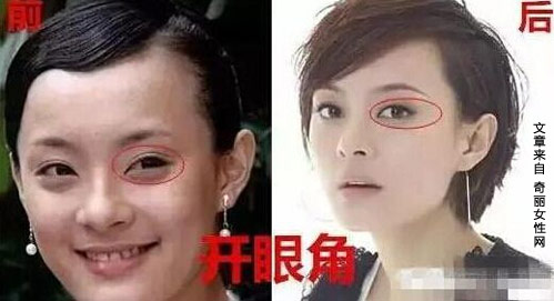 孙俪自曝整过容 整容前后开眼角垫下巴缩鼻头