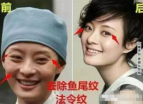 孙俪自曝整过容 整容前后开眼角垫下巴缩鼻头