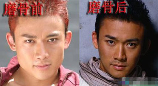 聂远整容削骨前后对比照片