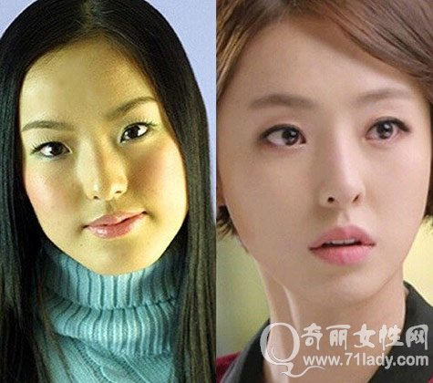 李多喜整容前后对比照