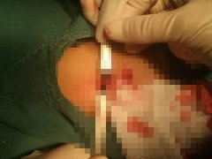 男童气管被狗咬穿 经两家医院接力抢救才保住性命